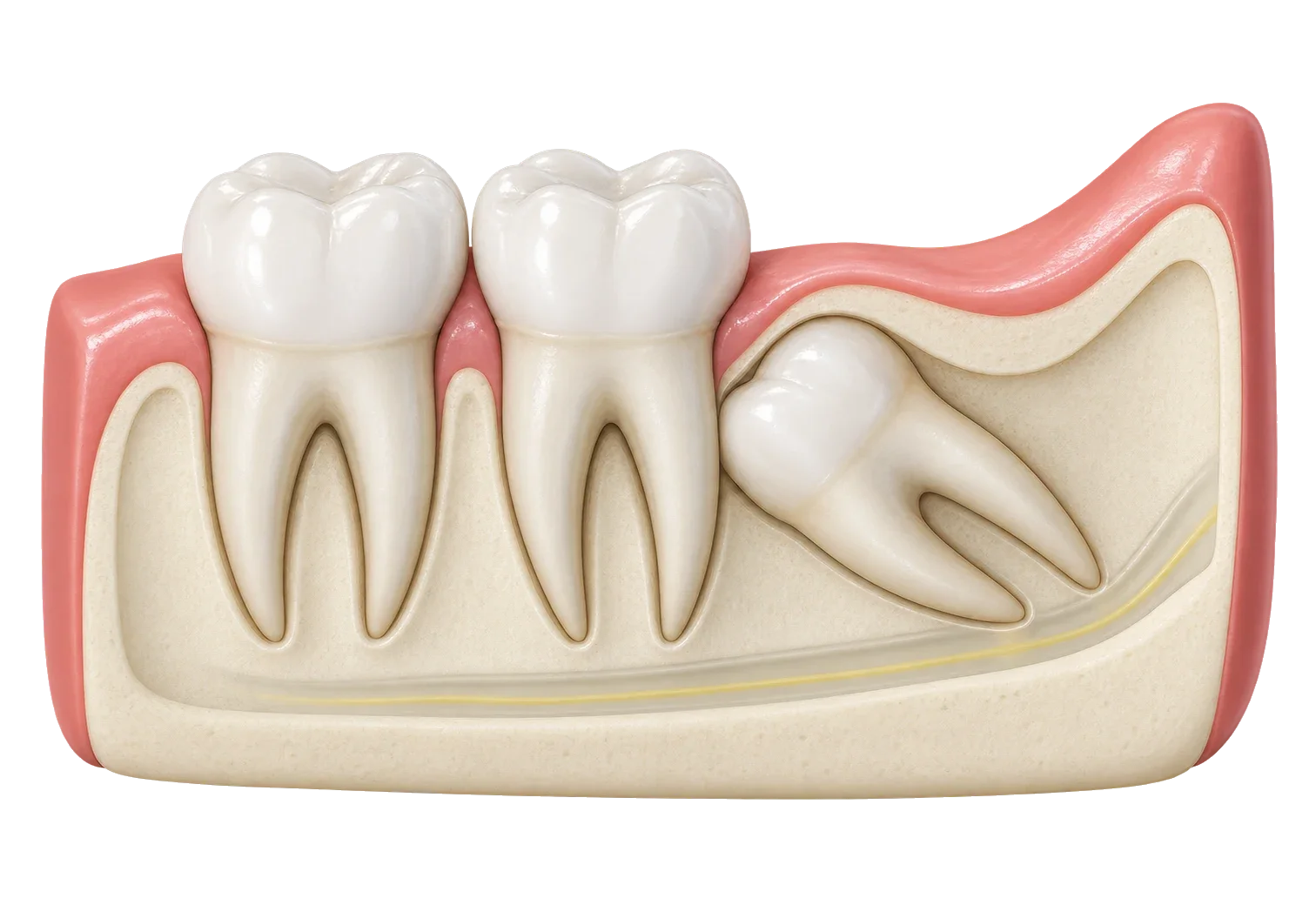 Ilustrație: secțiune prin mandibulă, cu un molar de minte inclus, înclinat sub gingie și os