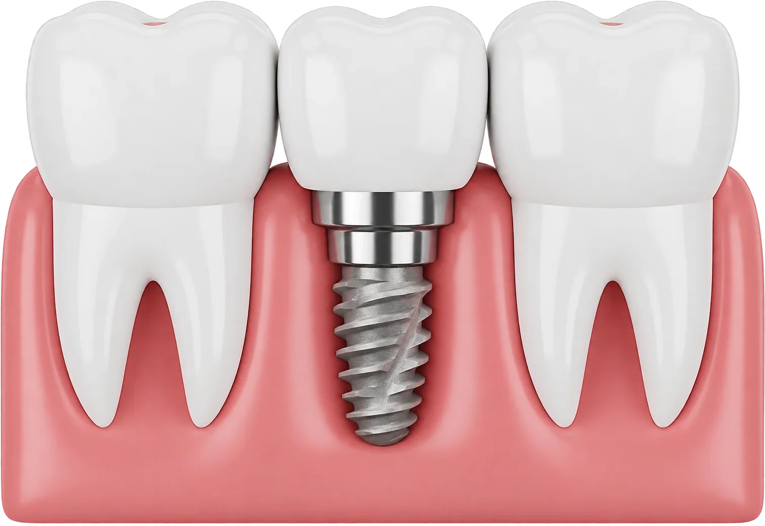 Coroană pe un implant conic cu filet larg, între doi dinți naturali
